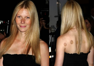 Gwyneth Paltrow with typical cupping marks.